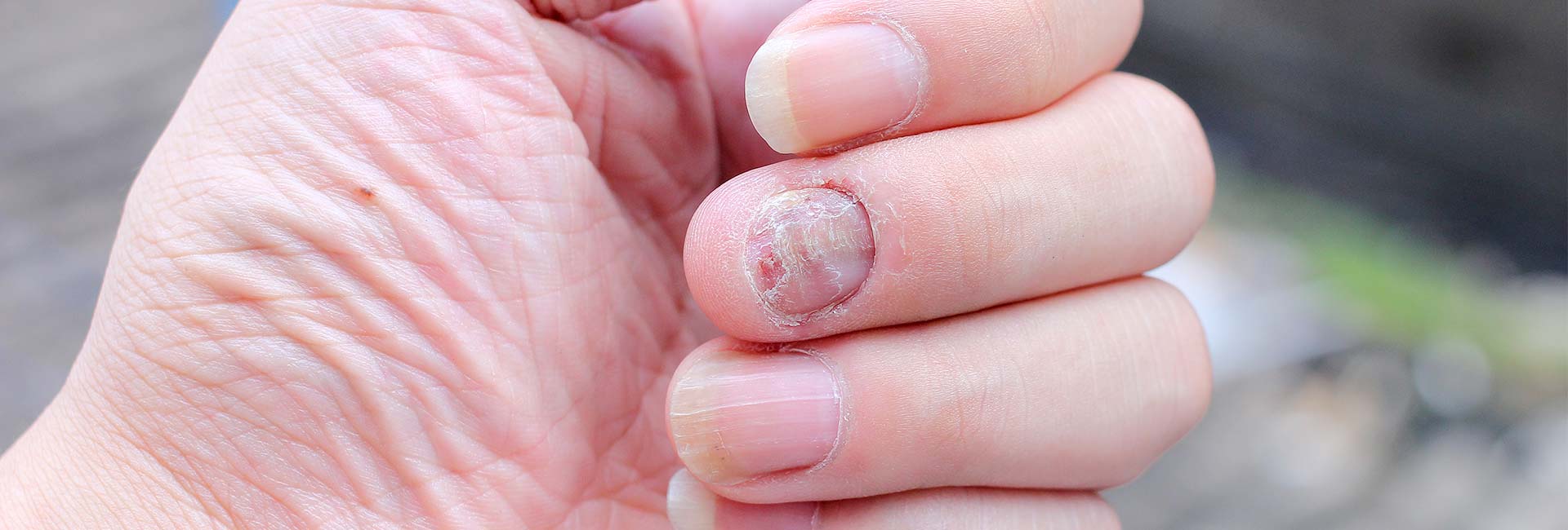 Fungus Infection on Nails Hand, Finger with onychomycosis.