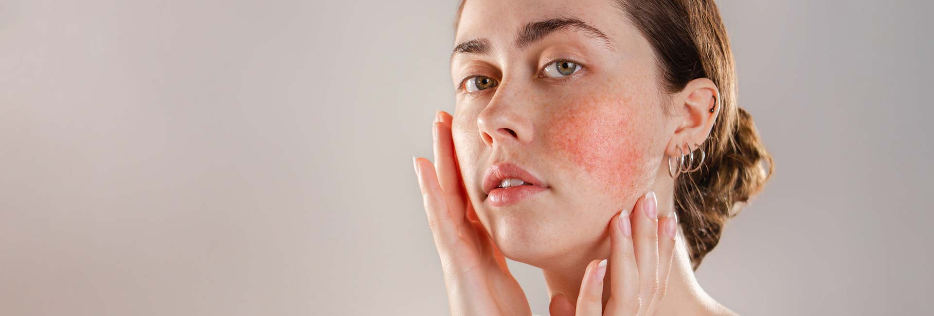 Rosacea and redness